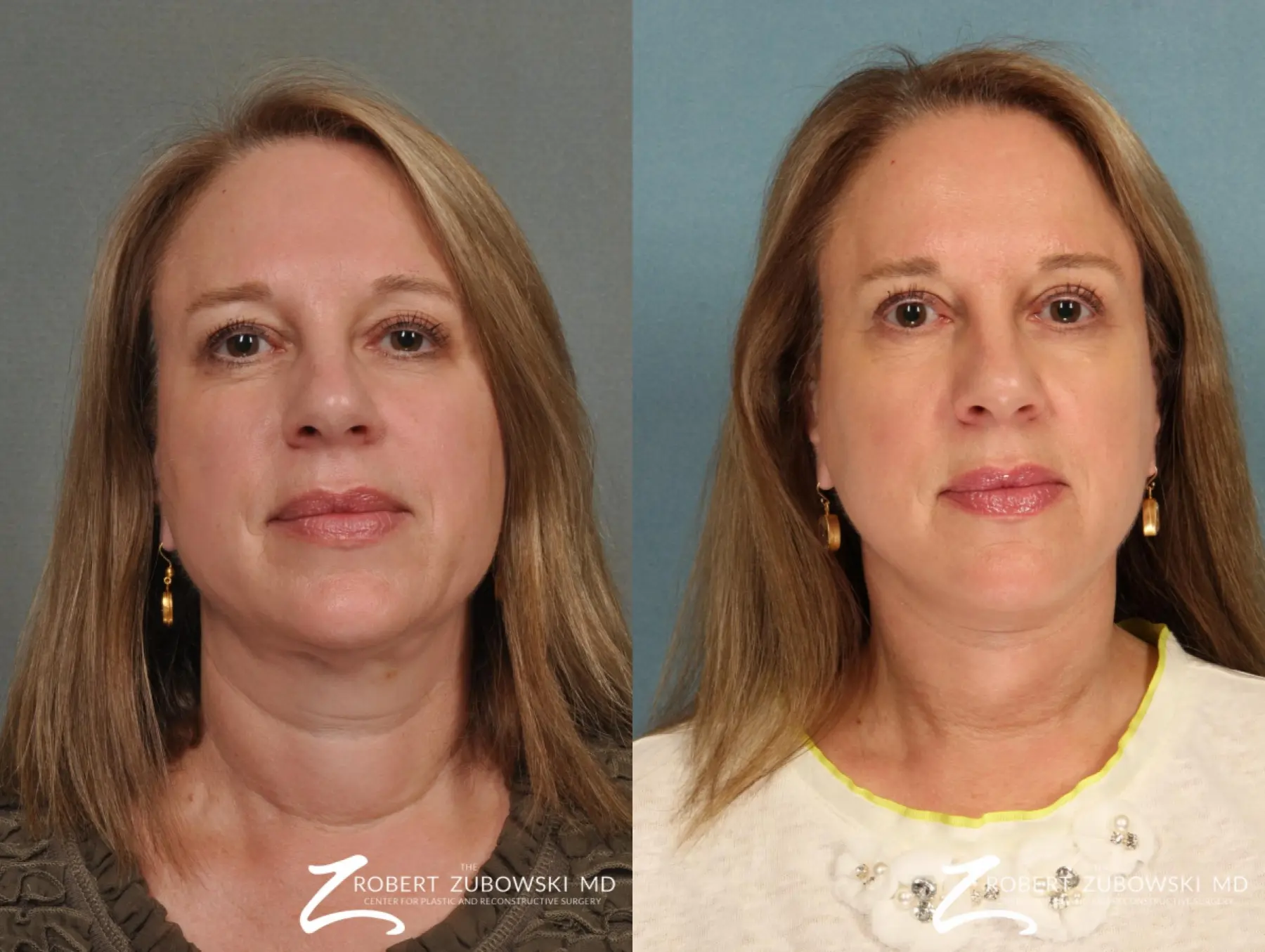 Blepharoplasty: Patient 7 - Before and After  