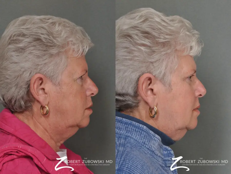 Blepharoplasty: Patient 23 - Before and After 2