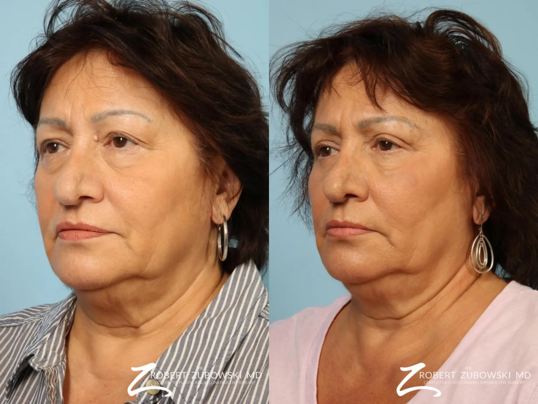 Blepharoplasty: Patient 26 - Before and After 2