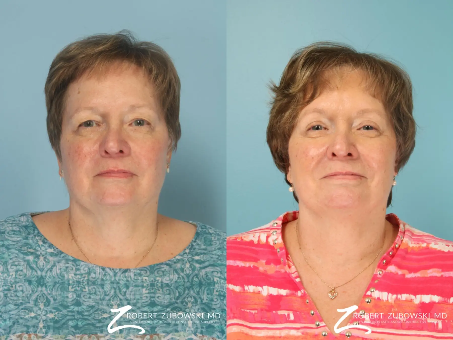 Blepharoplasty: Patient 38 - Before and After 1