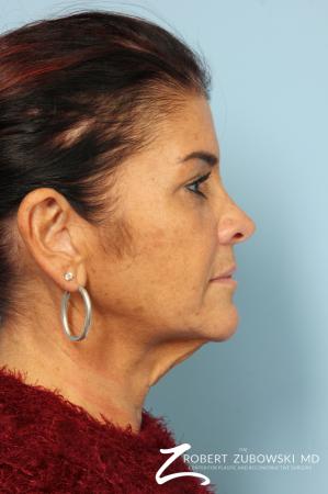 Neck Lift: Patient 10 - Before Image 2