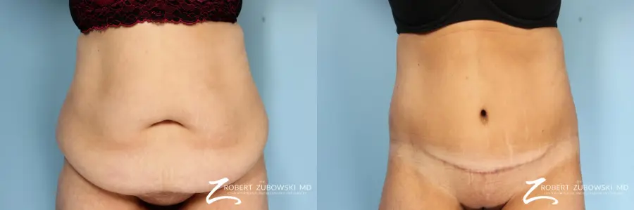 Body Lift: Patient 4 - Before and After 1