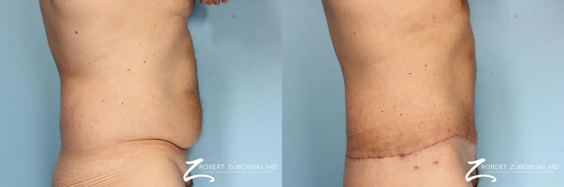 Body Lift For Men: Patient 1 - Before and After 3