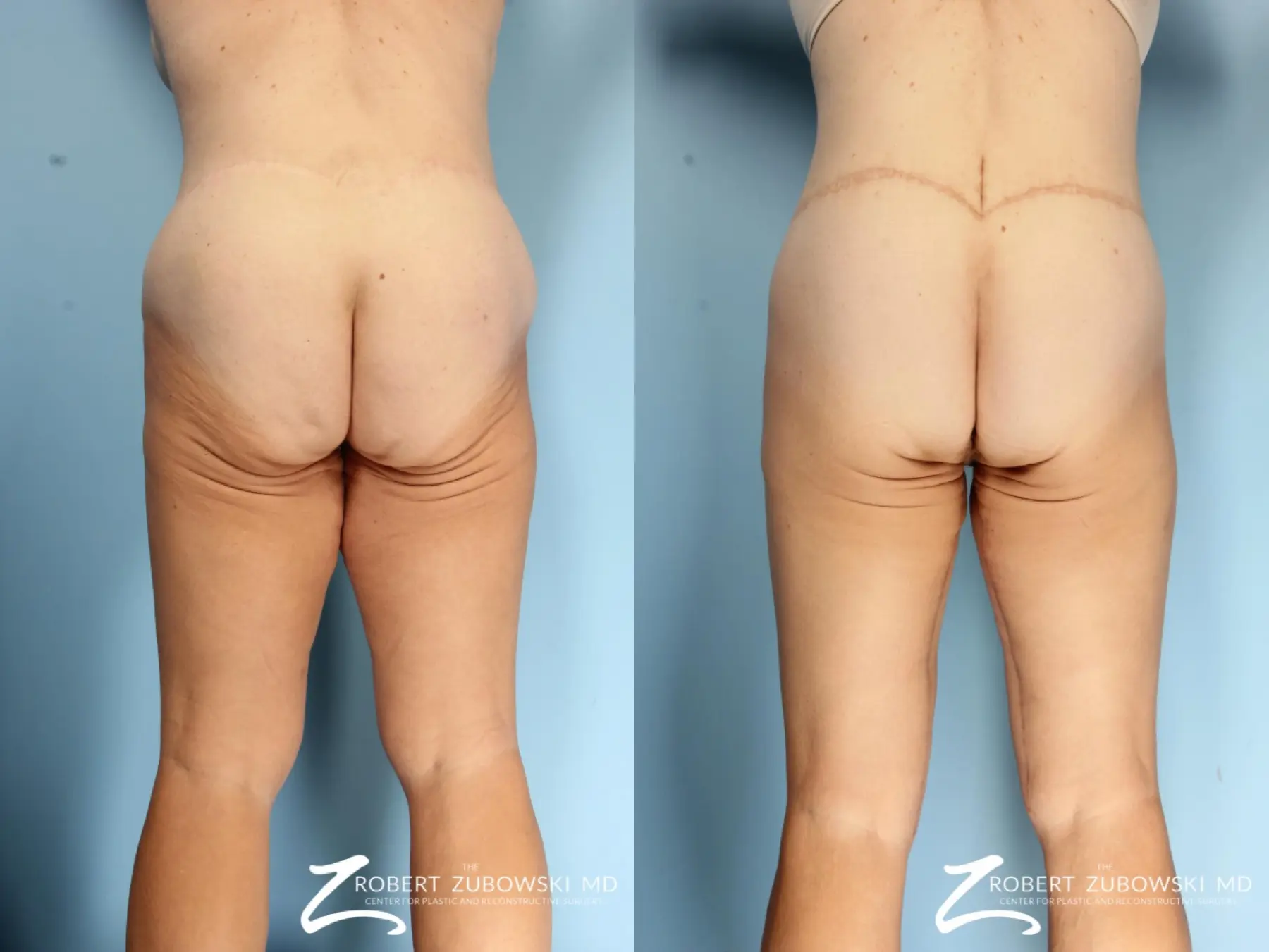 https://www.bragbook.gallery/assets/gallery/108/body-lift-before-and-after-6SM21MA3EaRv_highres.webp