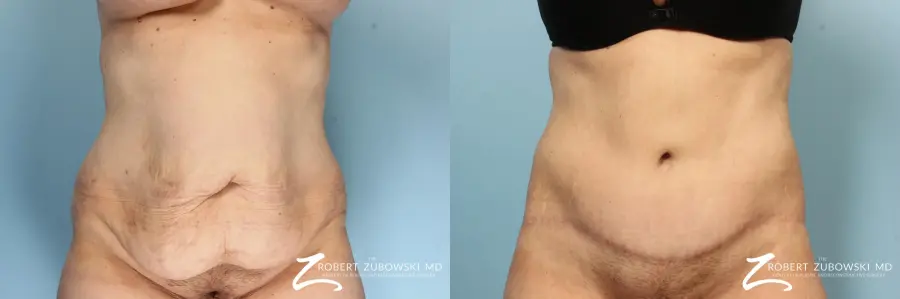 Body Lift: Patient 8 - Before and After  