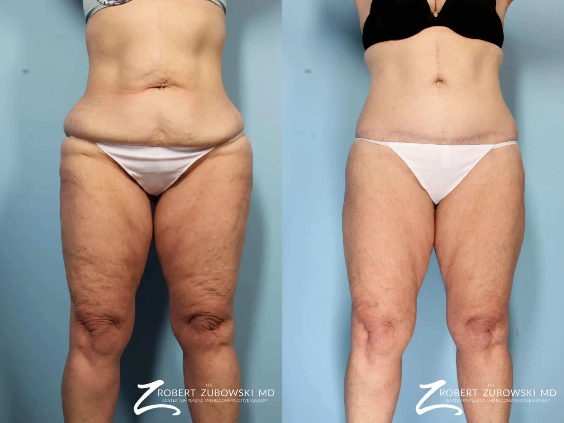 Body Lift: Patient 7 - Before and After  