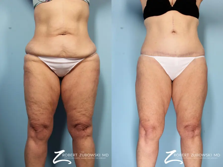 Body Lift: Patient 5 - Before and After  