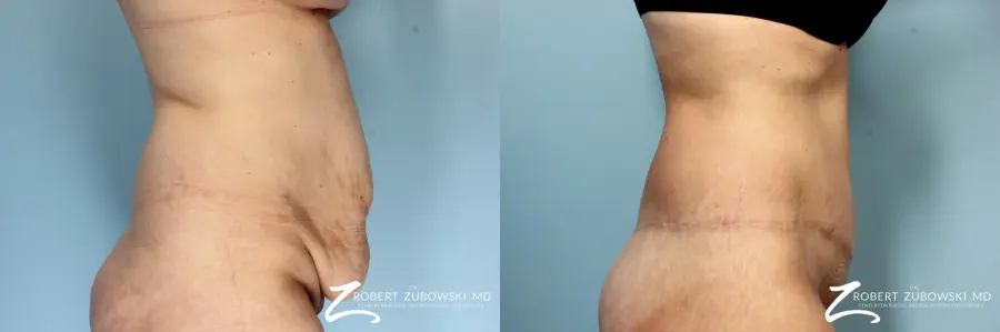 Body Lift: Patient 9 - Before and After 2