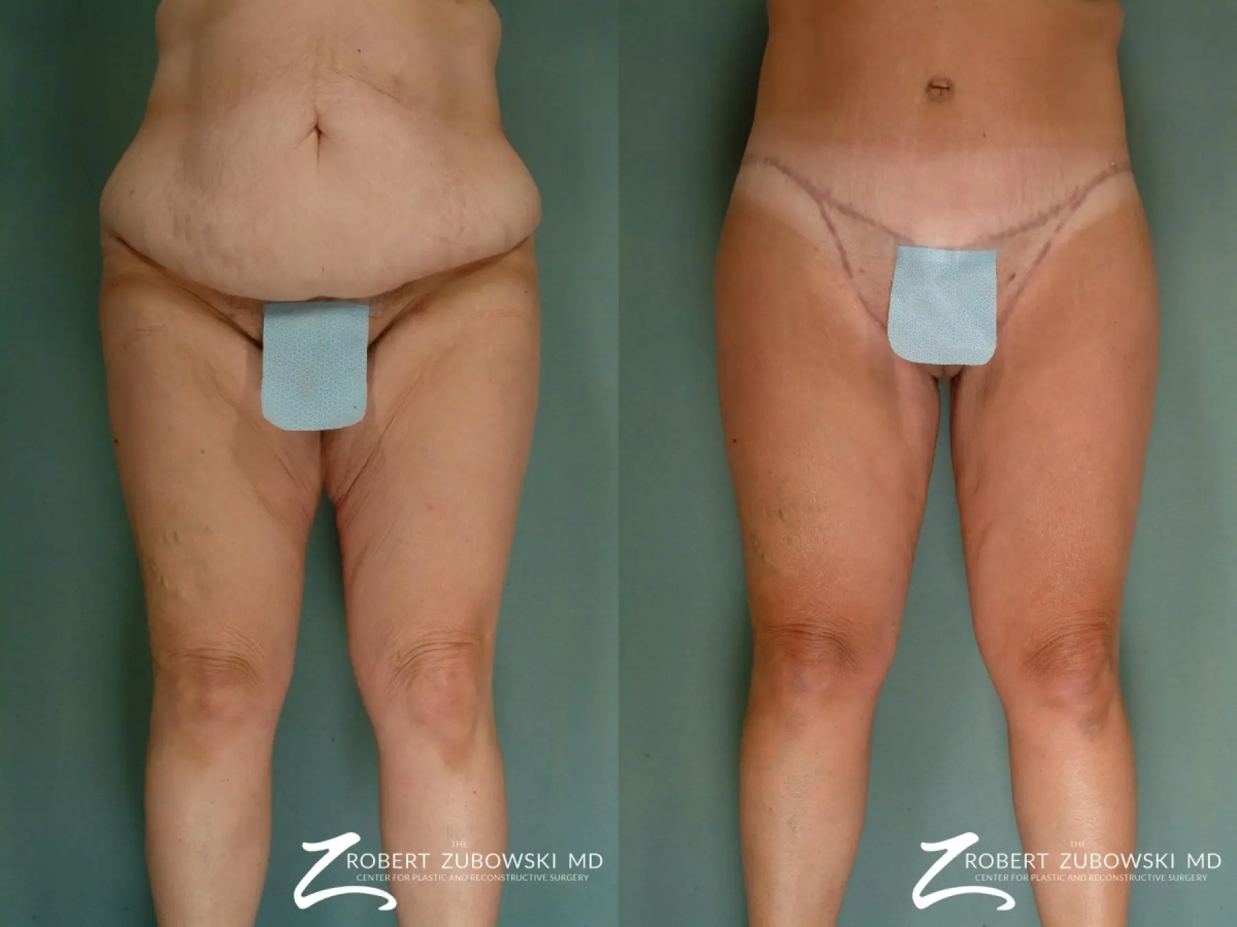 Body Lift: Patient 5 - Before and After  