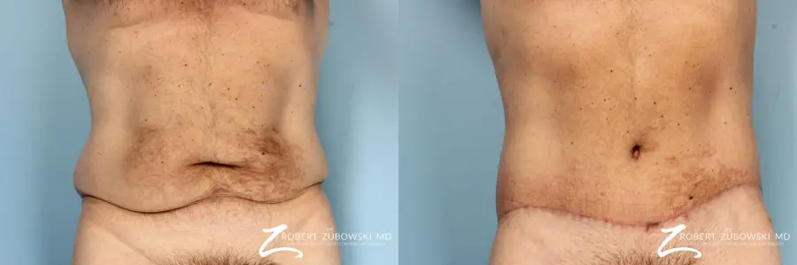 Body-lift-for-men: Patient 1 - Before and After  