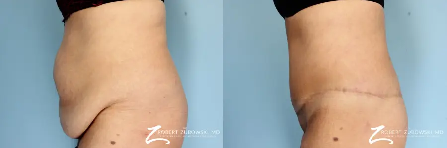 Body Lift: Patient 4 - Before and After 2