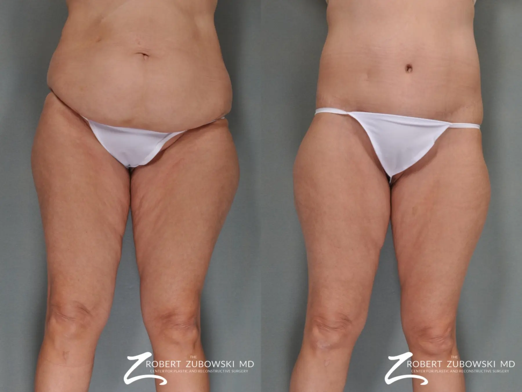 Body Lift: Patient 8 - Before and After 1