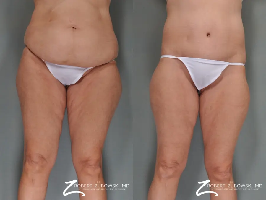 Body Lift: Patient 1 - Before and After  