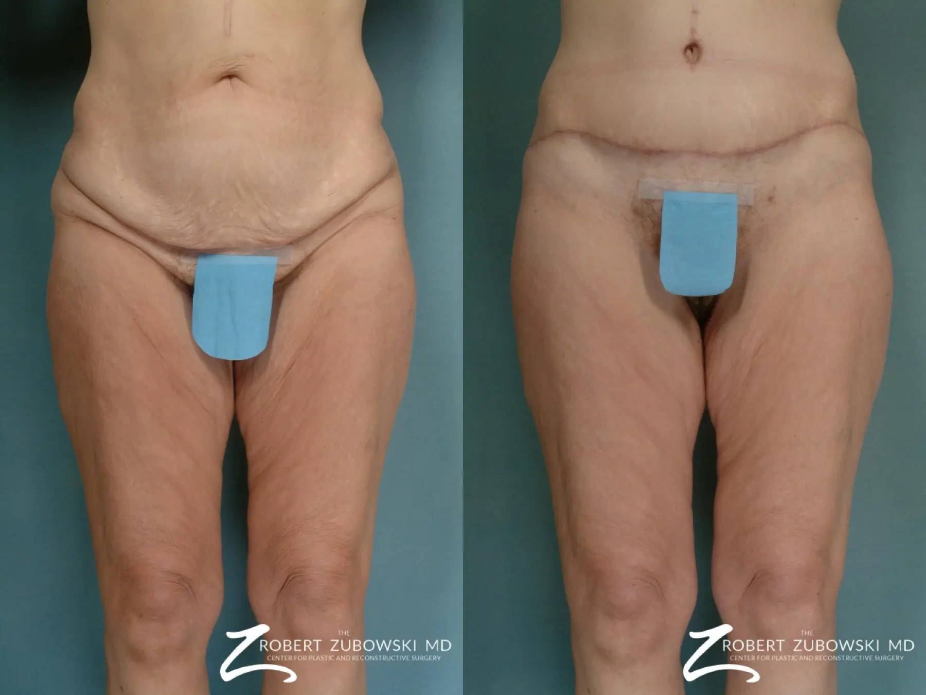 Body Lift: Patient 4 - Before and After  