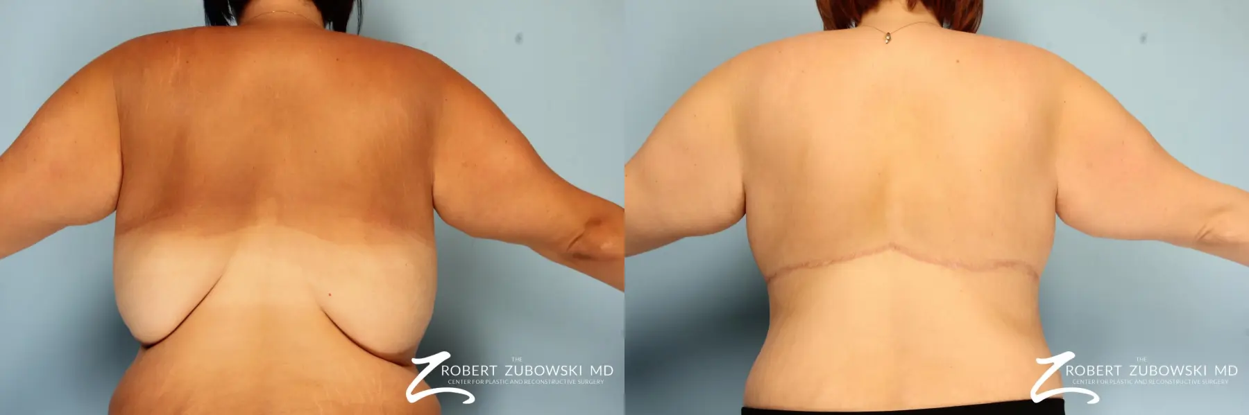 Upper Back Lift Before & After Gallery