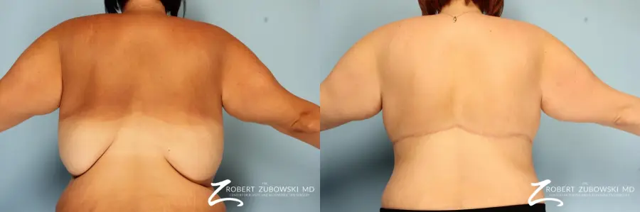 Body Lift: Patient 6 - Before and After 2