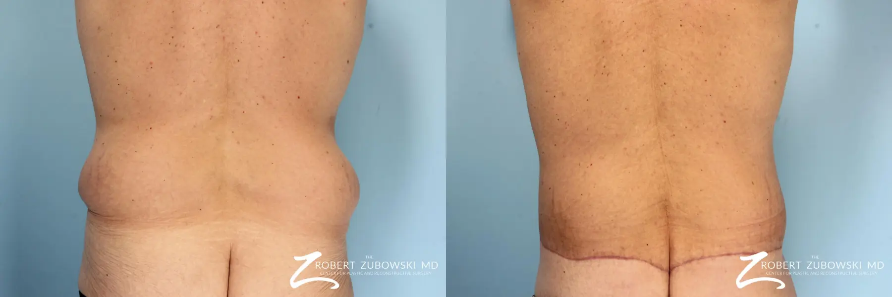 Body Lift For Men: Patient 1 - Before and After 2