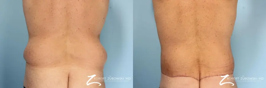 Body Lift: Patient 8 - Before and After 2
