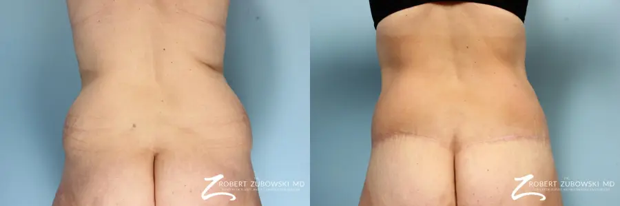 Body Lift: Patient 1 - Before and After 3