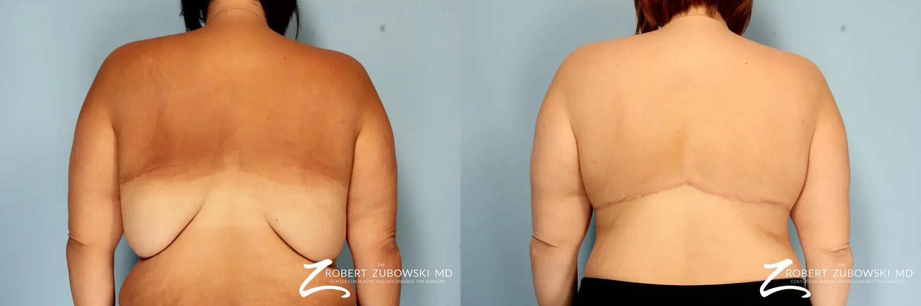 Body Lift: Patient 2 - Before and After 1