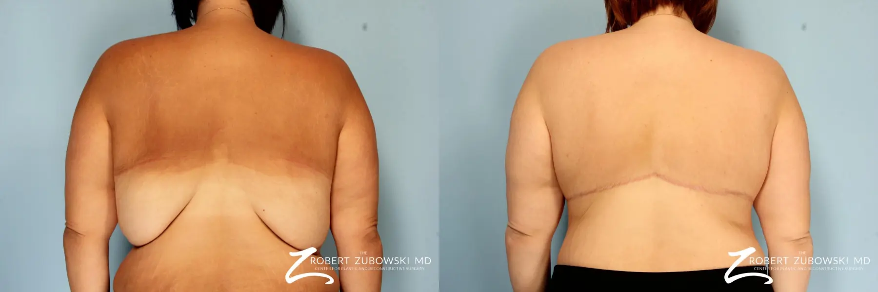 Body Lift: Patient 2 - Before and After  