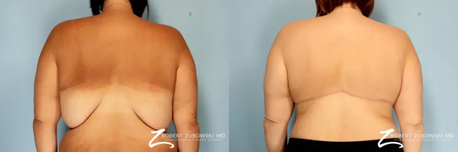 Body Lift: Patient 6 - Before and After  