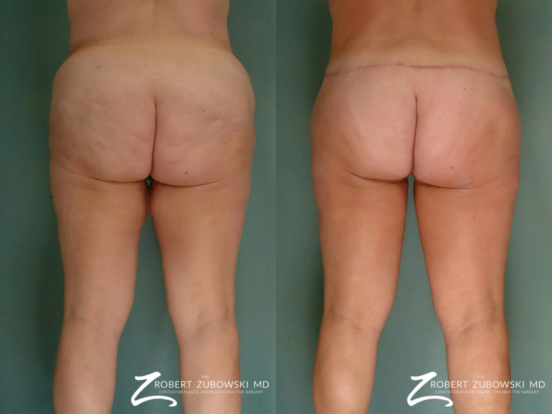 Body Lift: Patient 5 - Before and After 2
