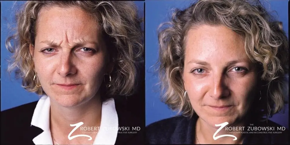 BOTOX® Cosmetic: Patient 1 - Before and After  