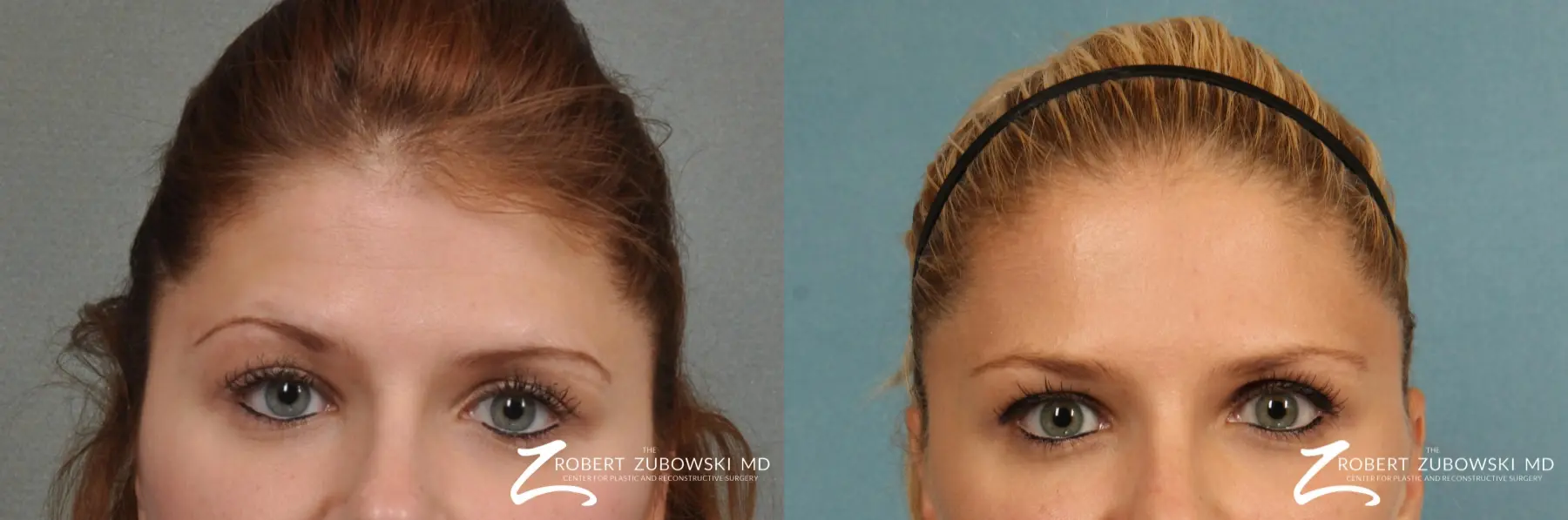 BOTOX® Cosmetic: Patient 3 - Before and After  