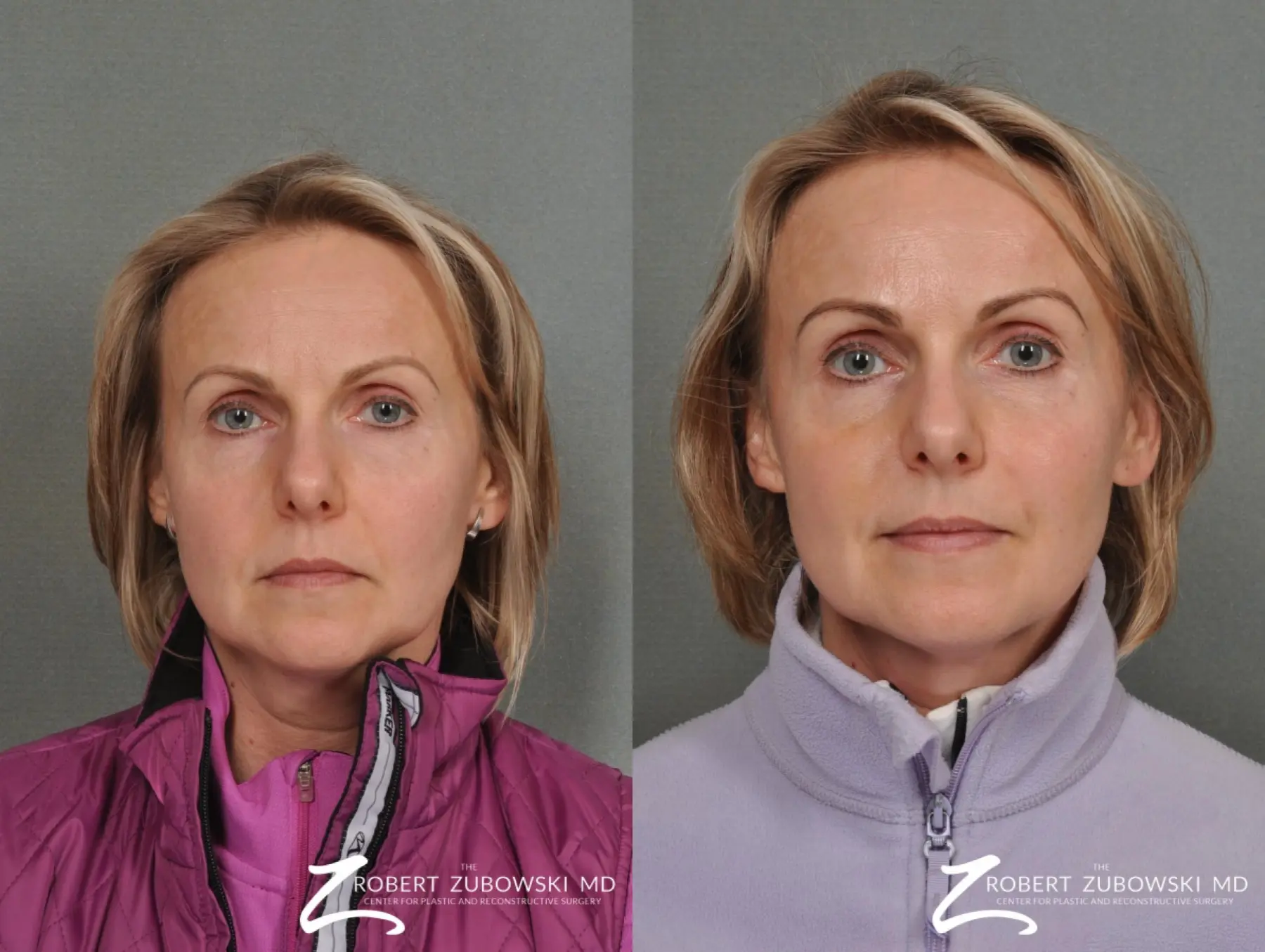 BOTOX® Cosmetic: Patient 2 - Before and After  