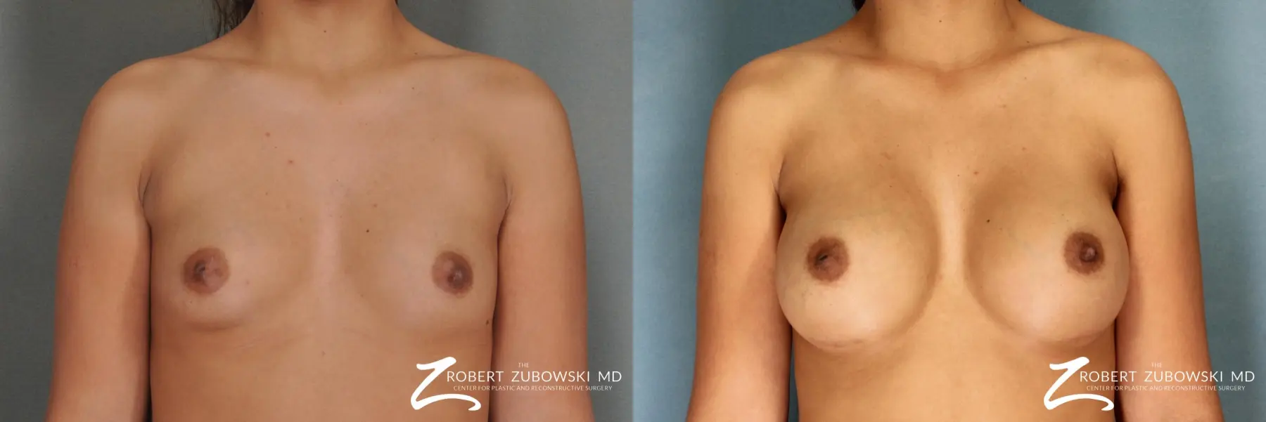 Breast Augmentation: Patient 8 - Before and After  