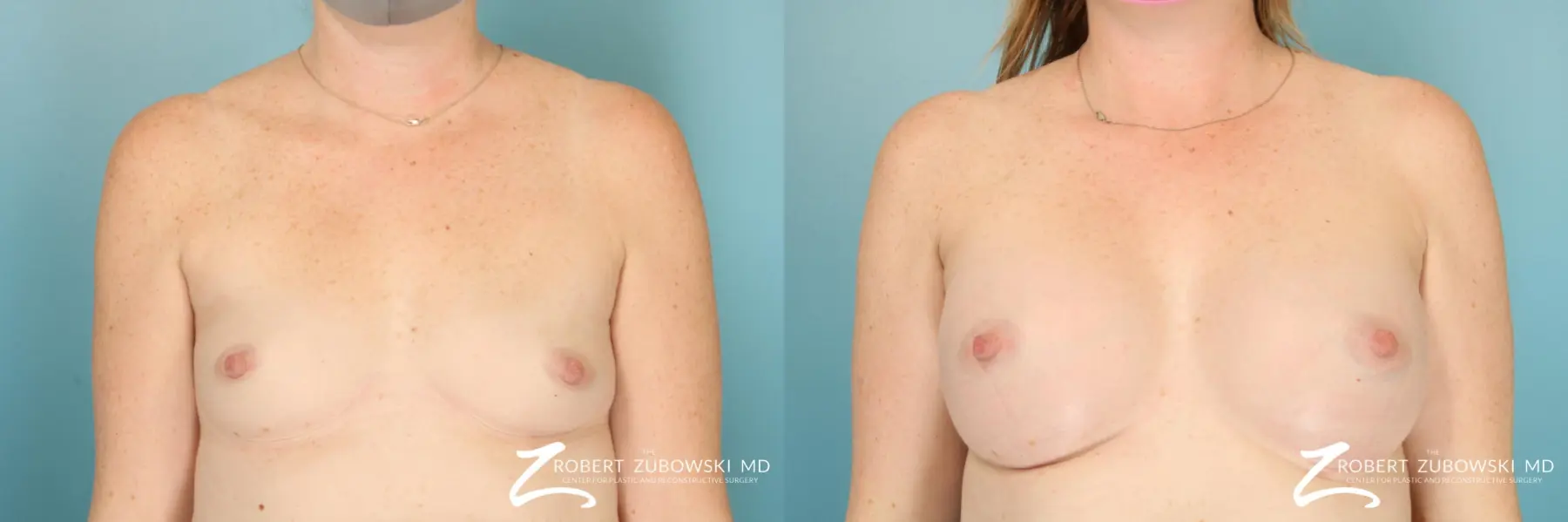 Breast Augmentation: Patient 42 - Before and After  