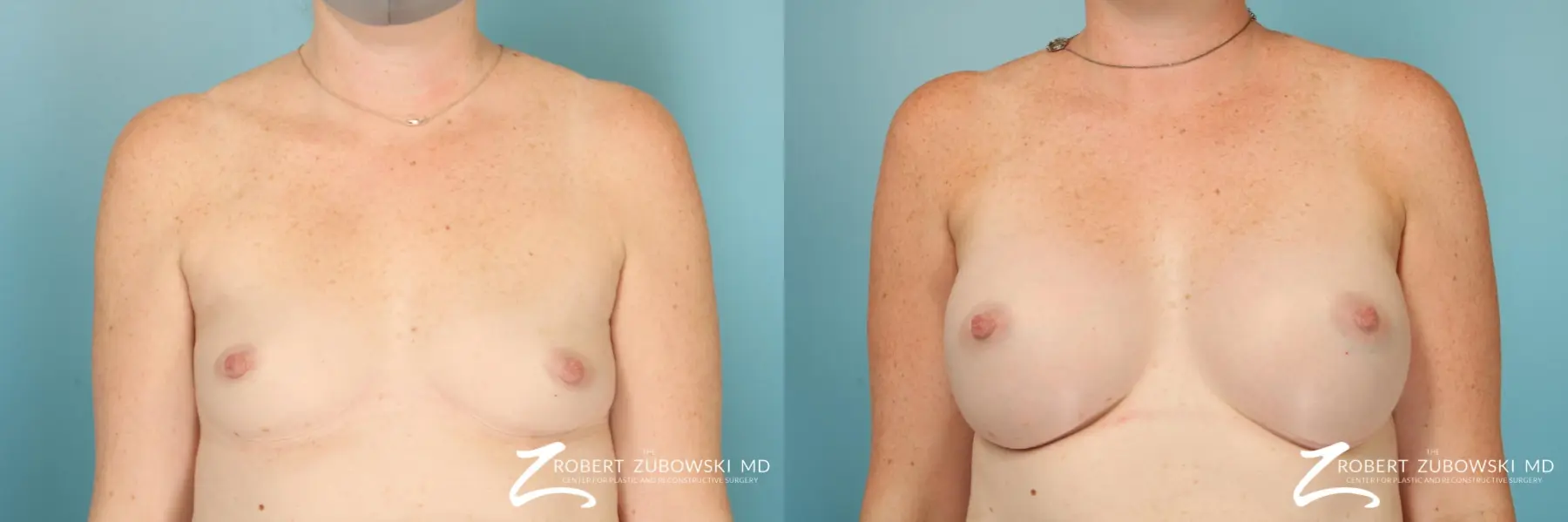 Breast Augmentation: Patient 43 - Before and After 1