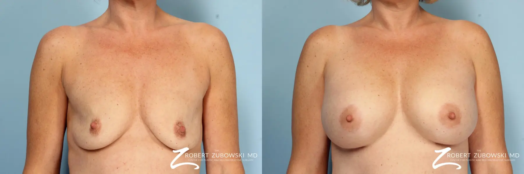 Breast Augmentation: Patient 38 - Before and After  