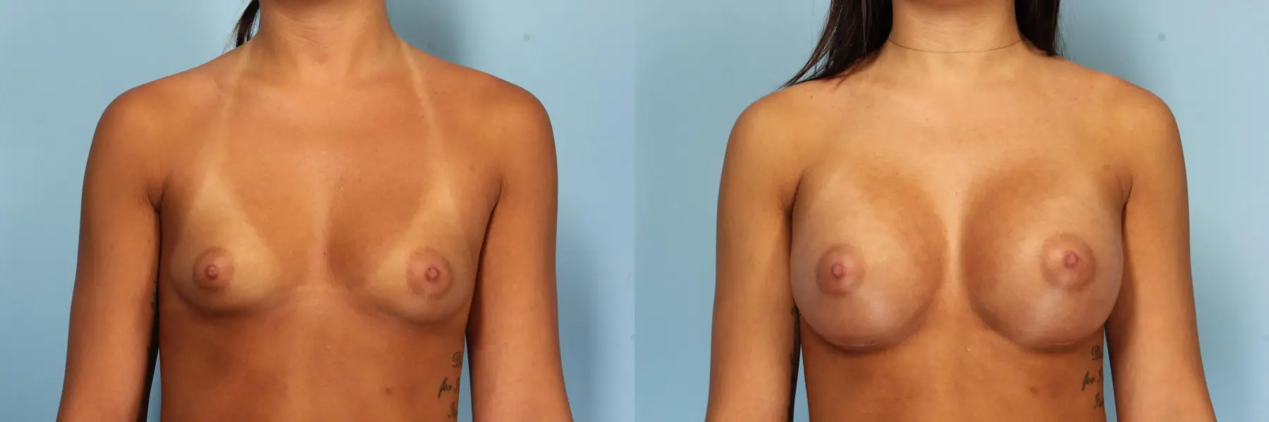 Breast Augmentation: Patient 34 - Before and After  