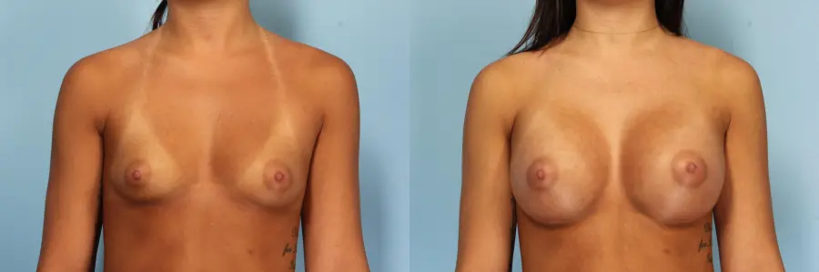 Breast Augmentation: Patient 34 - Before and After 1