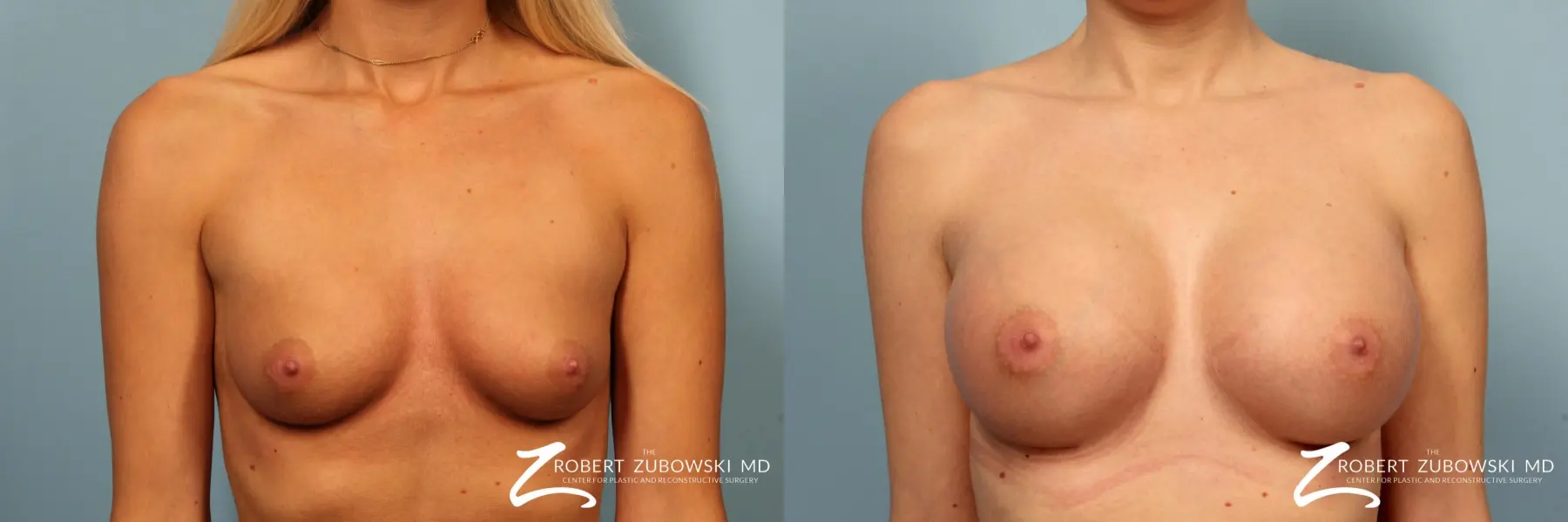 Breast Augmentation: Patient 9 - Before and After 1