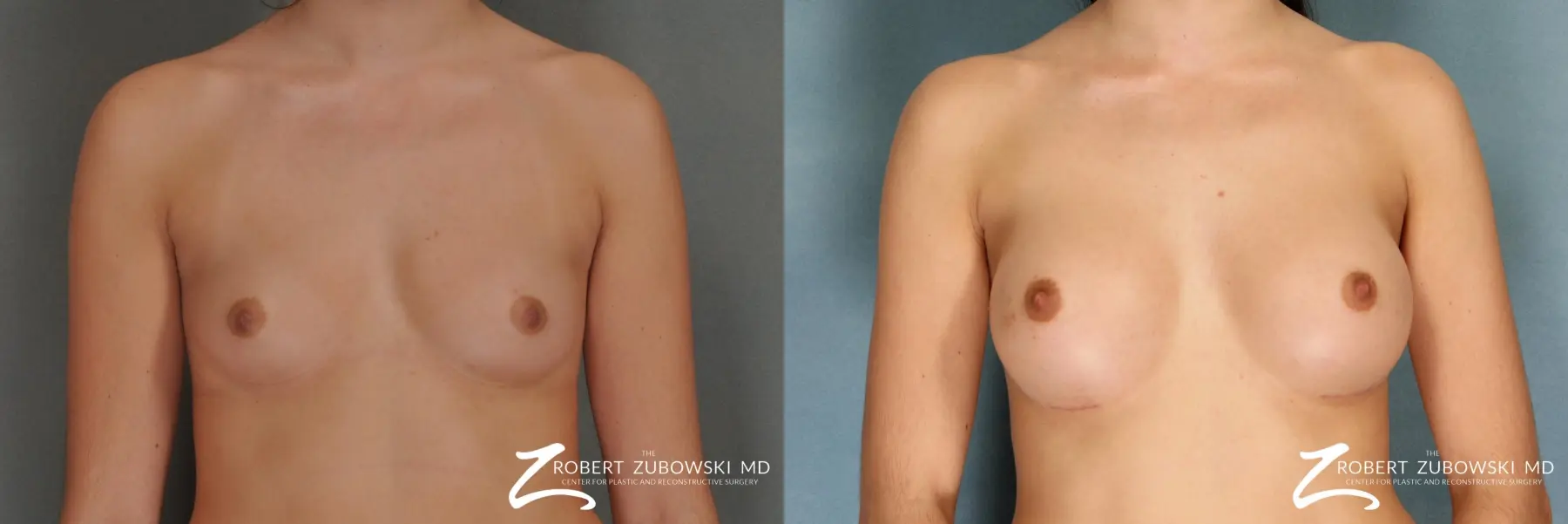 Breast Augmentation: Patient 15 - Before and After  