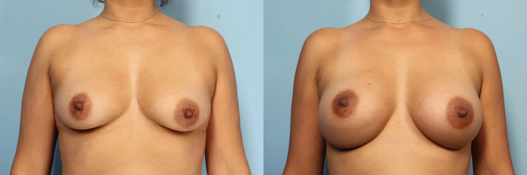 Breast Augmentation: Patient 33 - Before and After  