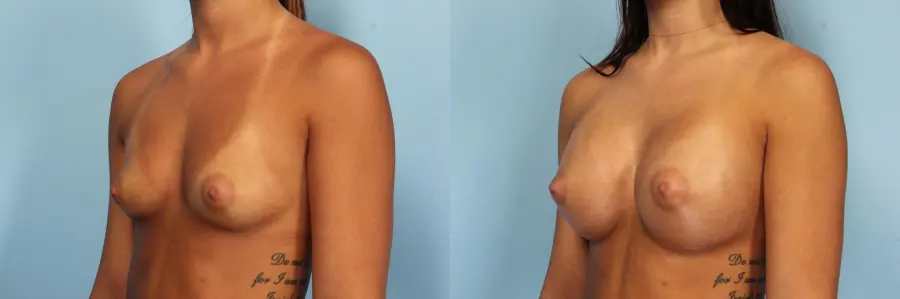 Breast Augmentation: Patient 34 - Before and After 3