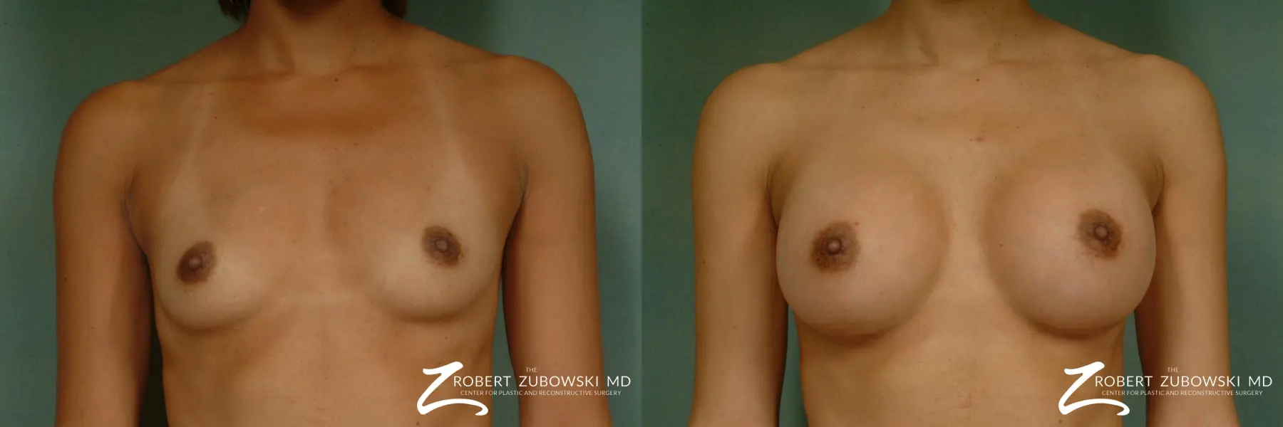 Breast Augmentation: Patient 32 - Before and After  