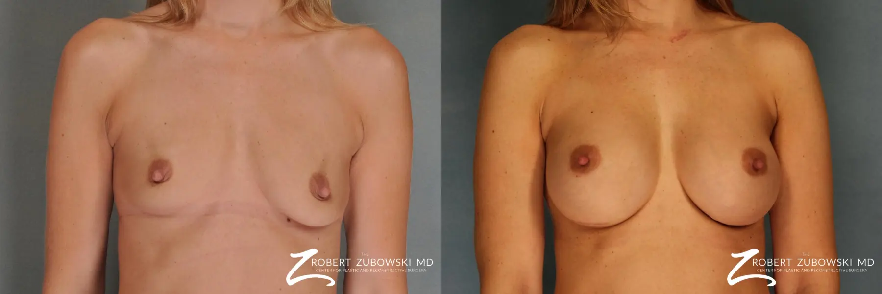 Breast Augmentation: Patient 14 - Before and After  