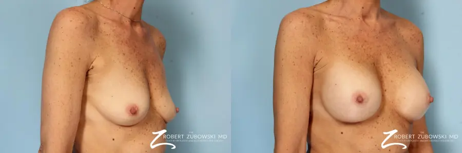 Breast Augmentation: Patient 39 - Before and After 2