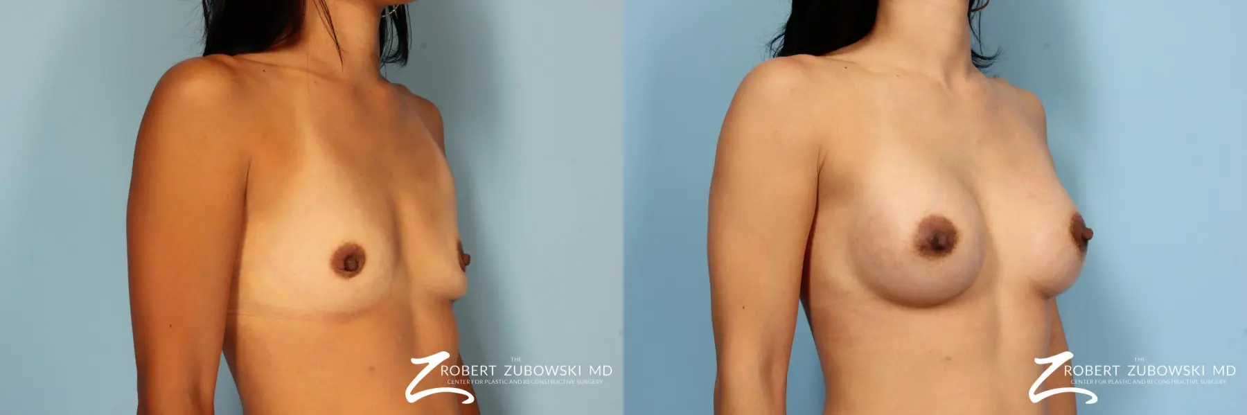 Breast Augmentation: Patient 2 - Before and After 3