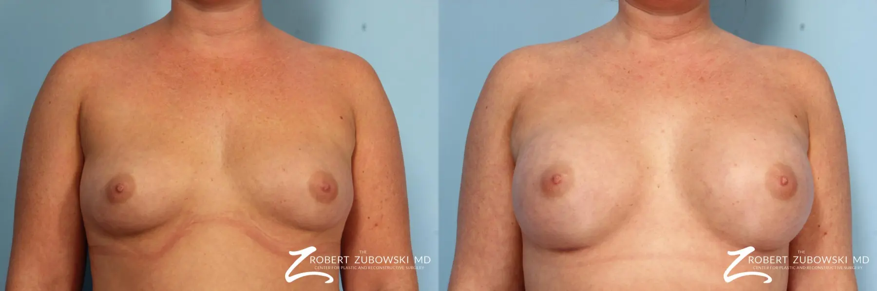 Breast Augmentation: Patient 7 - Before and After  