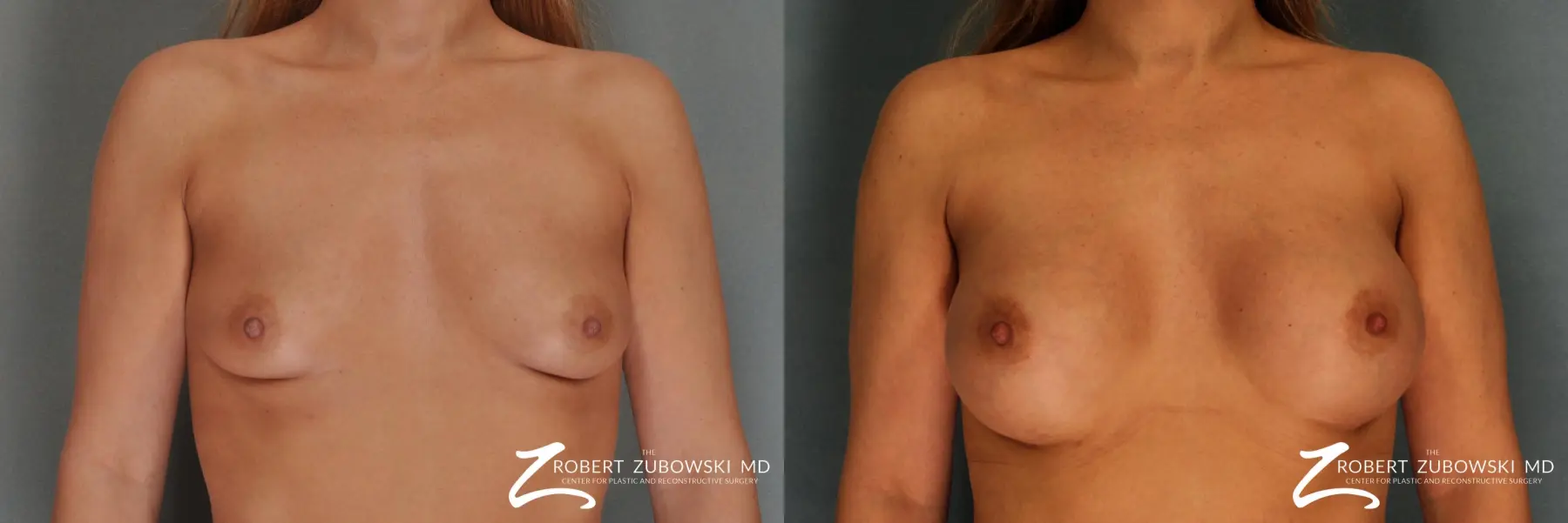 Breast Augmentation: Patient 13 - Before and After  