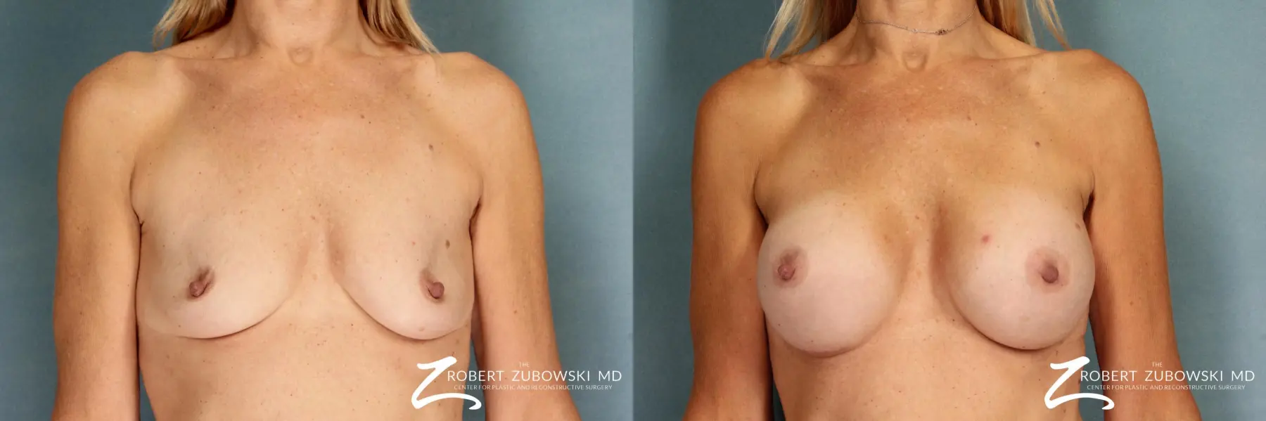 Breast Augmentation: Patient 12 - Before and After  