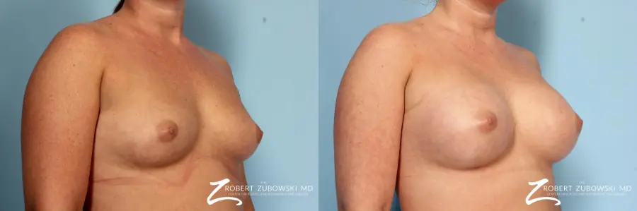 Breast Augmentation: Patient 7 - Before and After 2