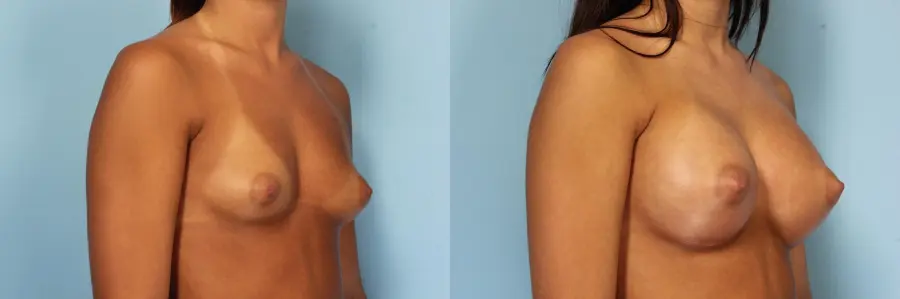Breast Augmentation: Patient 34 - Before and After 2
