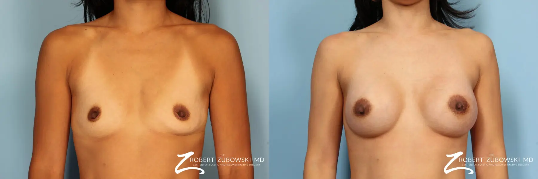 Breast Augmentation: Patient 2 - Before and After  